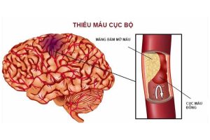 Thiếu máu não nên ăn gì? Top thực phẩm cho người thiếu máu não