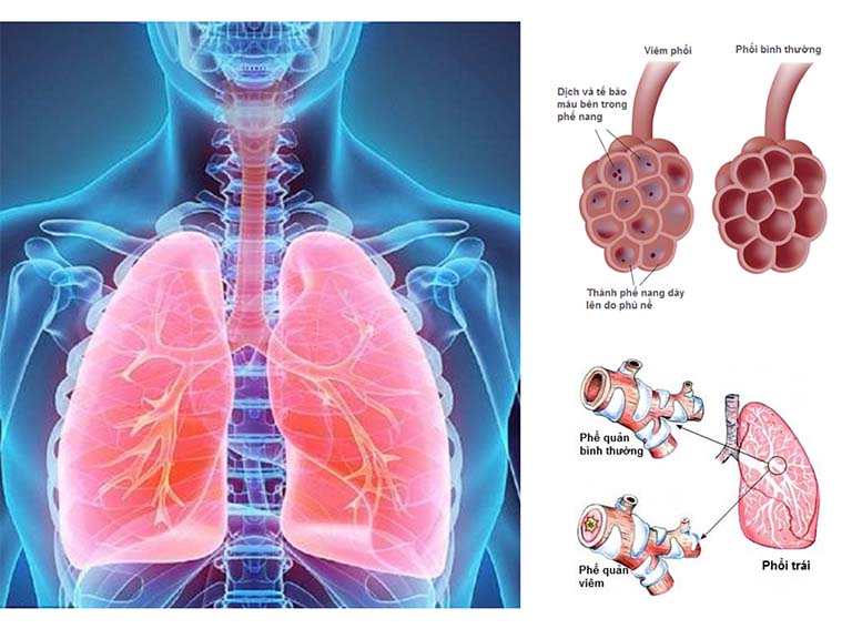 Phân biệt viêm phế quản và viêm phổi